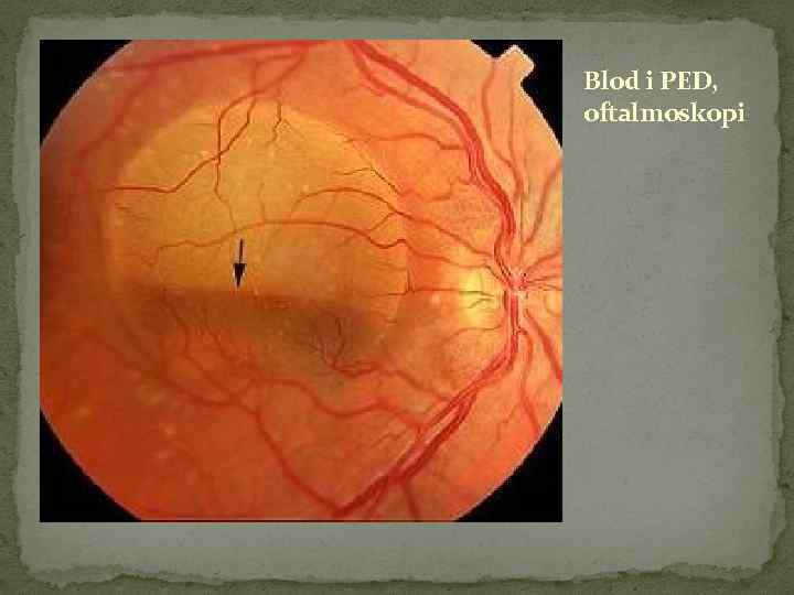 Blod i PED, oftalmoskopi 