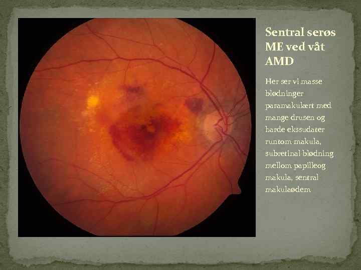 Sentral serøs ME ved våt AMD Her ser vi masse blødninger paramakulært med mange
