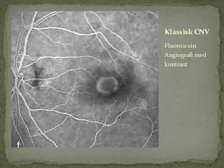 Klassisk CNV Fluoroscein Angiografi med kontrast 