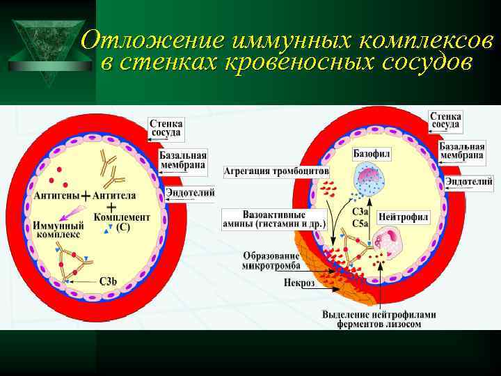 Отложение иммунных комплексов в стенках кровеносных сосудов 