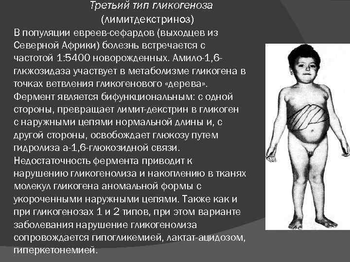  Третьий тип гликогеноза (лимитдекстриноз) В популяции евреев-сефардов (выходцев из Северной Африки) болезнь встречается