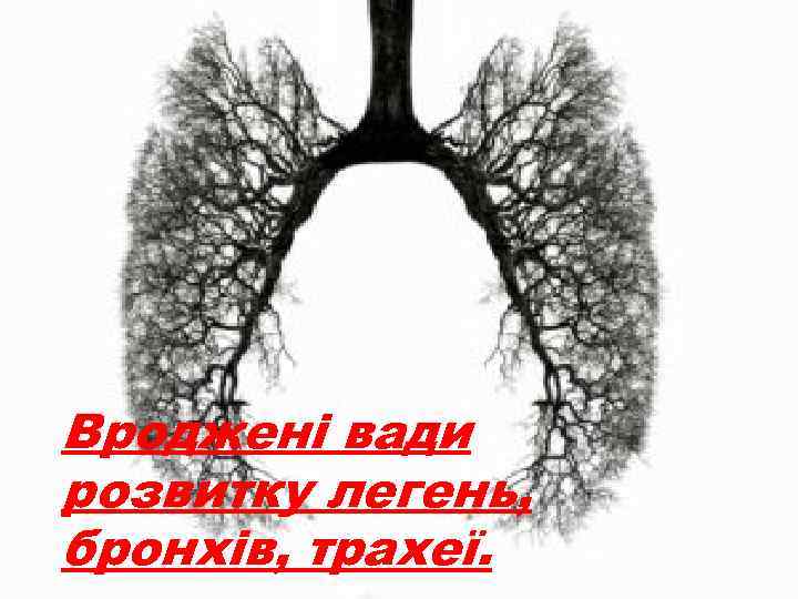 Вроджені вади розвитку легень, бронхів, трахеї. 