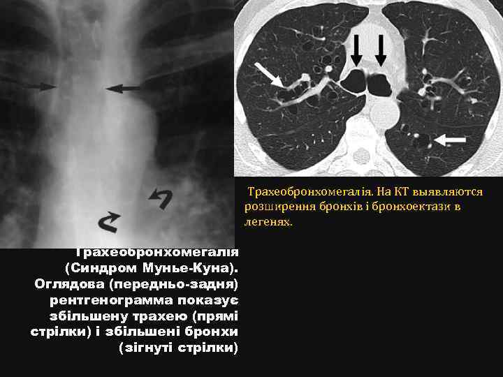 Трахеобронхомегалія. На КТ выявляются розширення бронхів і бронхоектази в легенях. Трахеобронхомегалія (Синдром Мунье-Куна). Оглядова