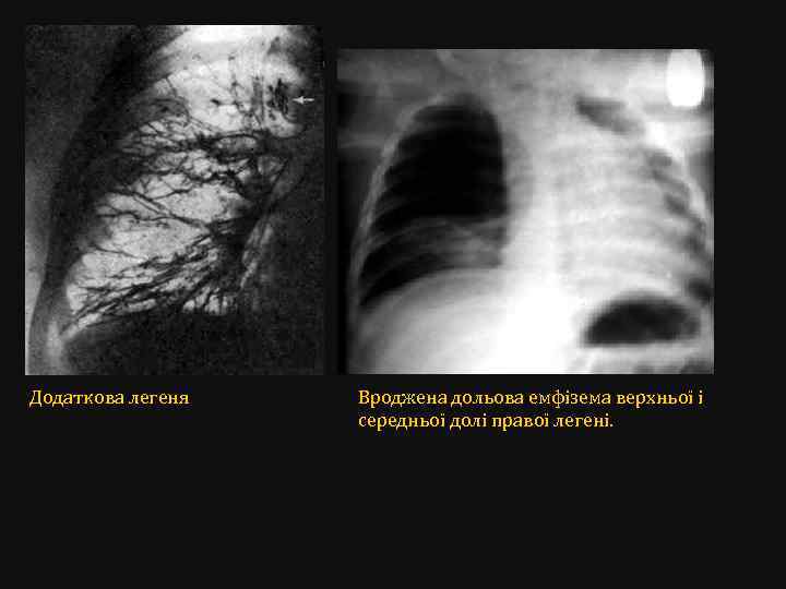 Додаткова легеня Вроджена дольова емфізема верхньої і середньої долі правої легені. 