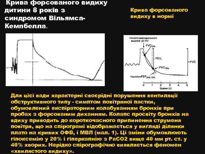 Крива форсованого видиху дитини 8 років з синдромом Вільямса. Кемпбелла. Крива форсованого видиху в