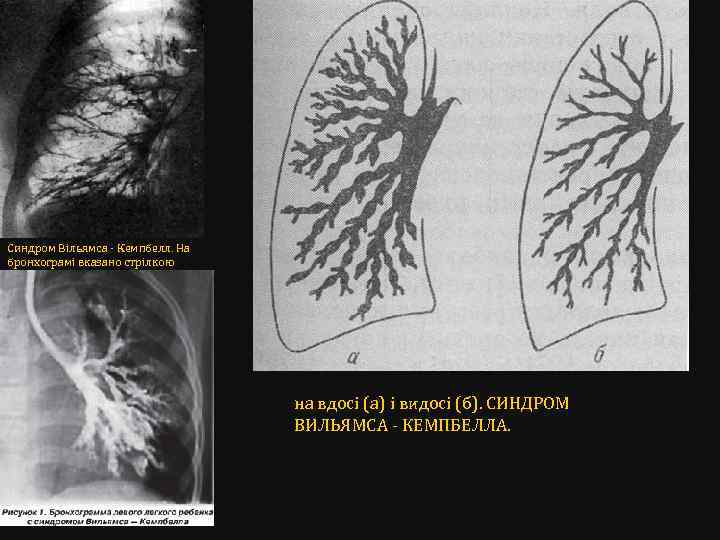 Синдром Вільямса - Кемпбелл. На бронхограмі вказано стрілкою на вдосі (а) і видосі (б).