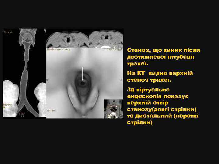 Стеноз, що виник після двотижневої інтубації трахеї. На КТ видно верхній стеноз трахеї. 3