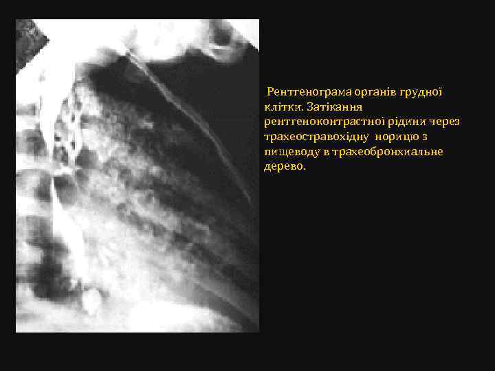 Рентгенограма органів грудної клітки. Затікання рентгеноконтрастної рідини через трахеостравохідну норицю з пищеводу в трахеобронхиальне