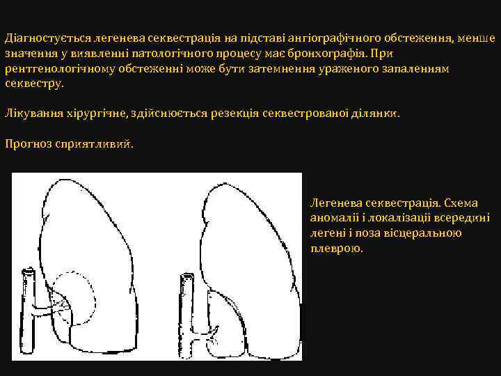 Діагностується легенева секвестрація на підставі ангіографічного обстеження, менше значення у виявленні патологічного процесу має