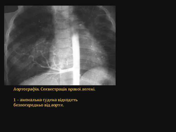 Аортографія. Секвестрація правої легені. 1 – аномальна судина відходить безпосередньо від аорти. 