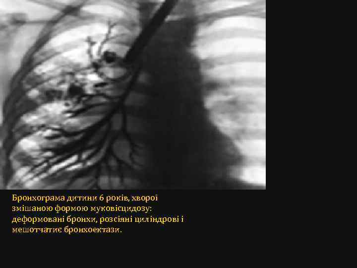 Бронхограма дитини 6 років, хворої змішаною формою муковісцидозу: деформовані бронхи, розсіяні циліндрові і мешотчатиє