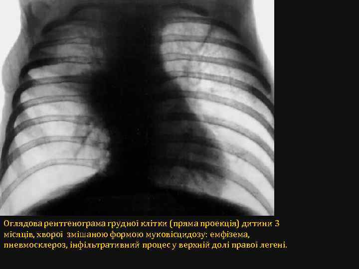 Оглядова рентгенограма грудної клітки (пряма проекція) дитини 3 місяців, хворої змішаною формою муковісцидозу: емфізема,