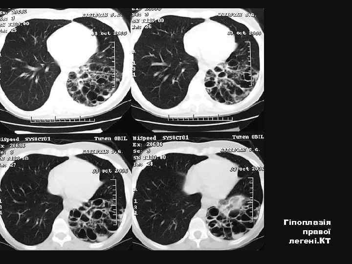 Гіпоплазія правої легені. КТ 