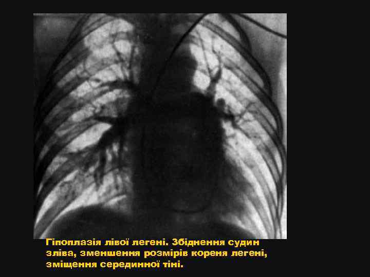 Гіпоплазія лівої легені. Збіднення судин зліва, зменшення розмірів кореня легені, зміщення серединної тіні. 