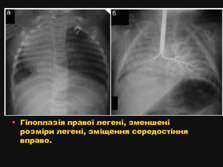  • Гіпоплазія правої легені, зменшені розміри легені, зміщення середостіння вправо. 