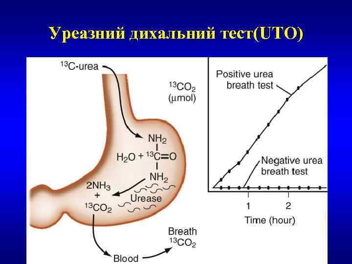 Уреазний дихальний тест(UTO) 