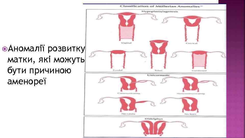  Аномалії розвитку матки, які можуть бути причиною аменореї 