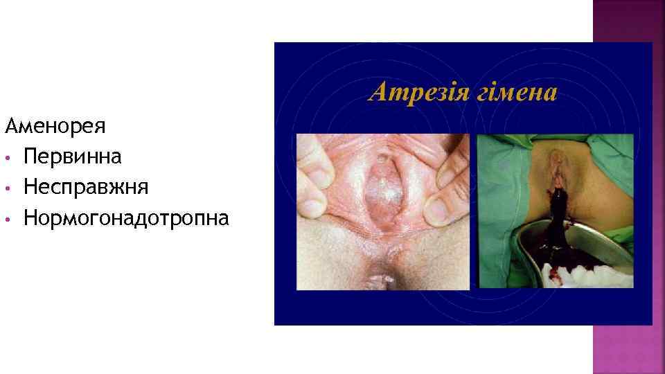 Аменорея • Первинна • Несправжня • Нормогонадотропна 