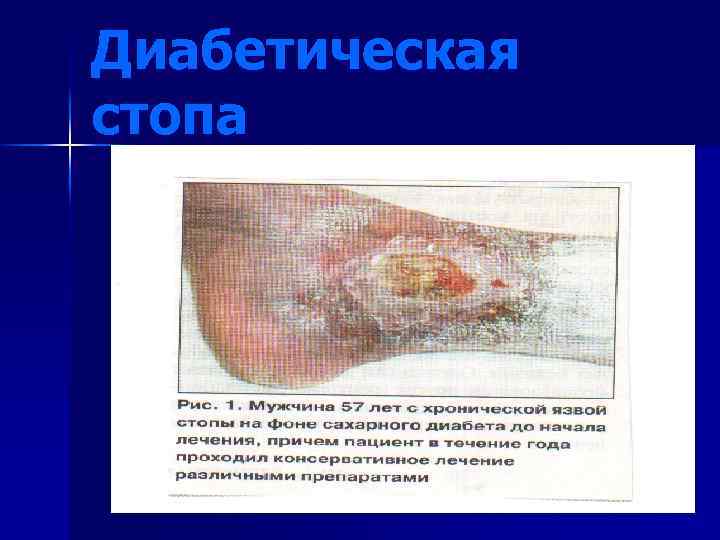 Диабетическая стопа 