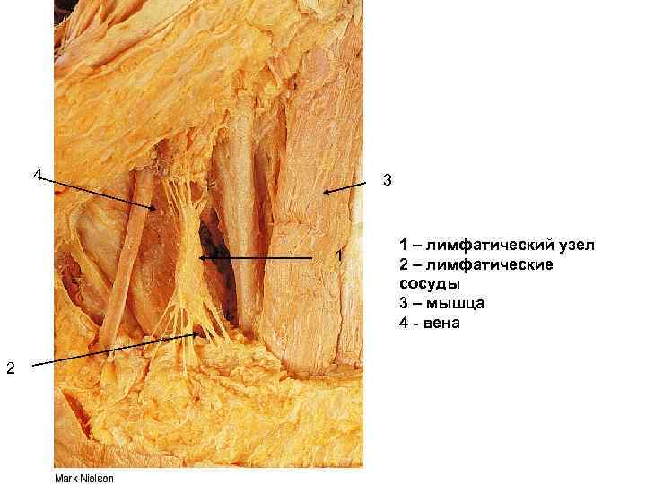 4 3 1 2 1 – лимфатический узел 2 – лимфатические сосуды 3 –