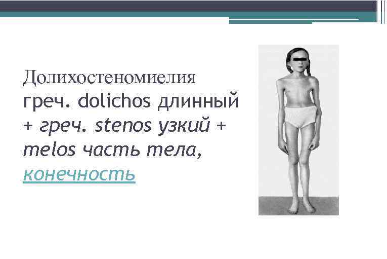 Долихостеномиелия греч. dolichos длинный + греч. stenos узкий + melos часть тела, конечность 