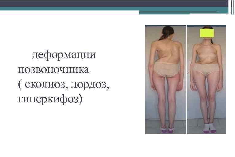 деформации позвоночника ( сколиоз, лордоз, гиперкифоз) 