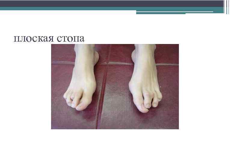 плоская стопа 