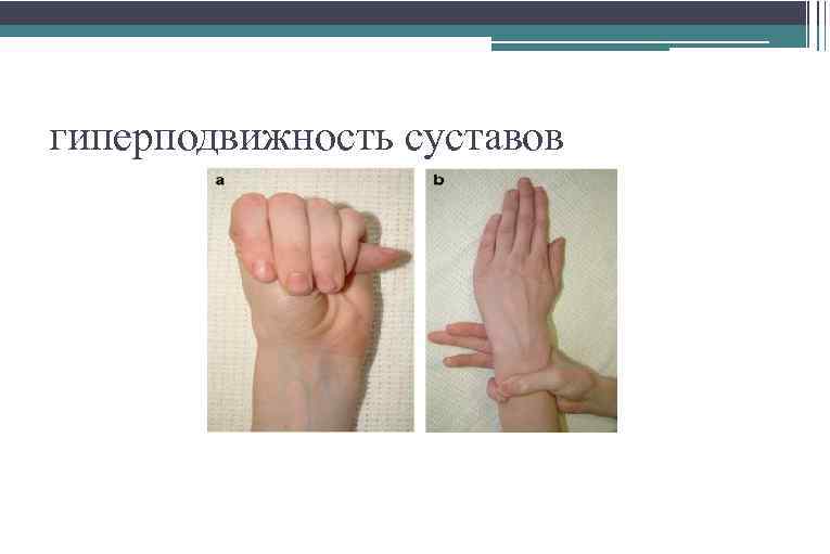 гиперподвижность суставов 