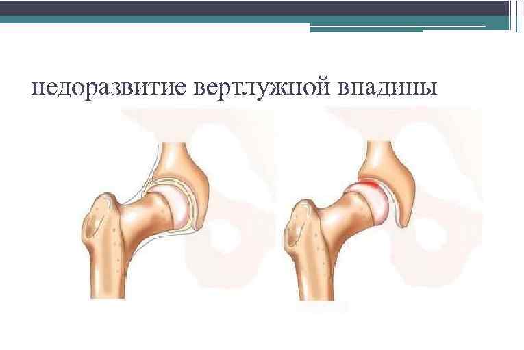 недоразвитие вертлужной впадины 