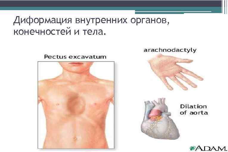 Диформация внутренних органов, конечностей и тела. 