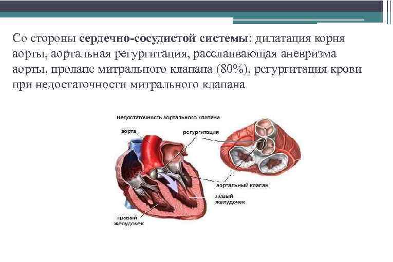Со стороны сердечно-сосудистой системы: дилатация корня аорты, аортальная регургитация, расслаивающая аневризма аорты, пролапс митрального