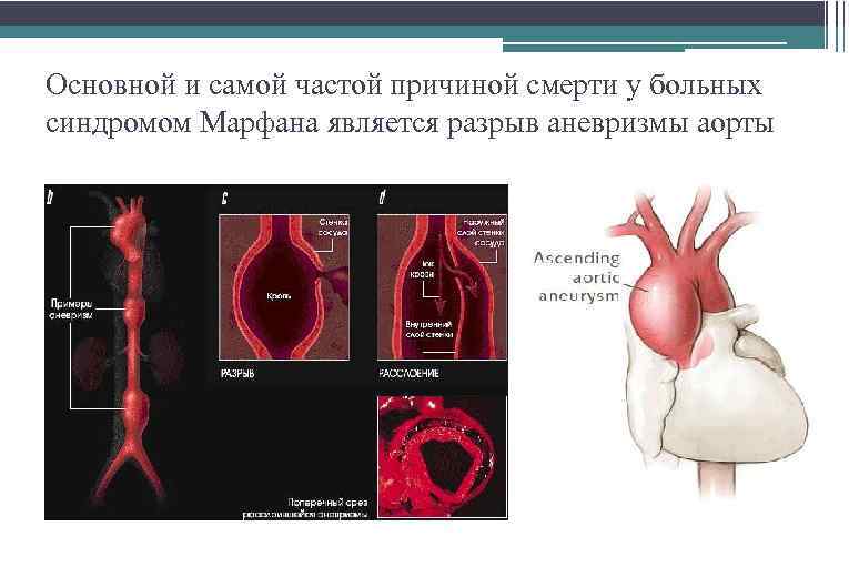Основной и самой частой причиной смерти у больных синдромом Марфана является разрыв аневризмы аорты