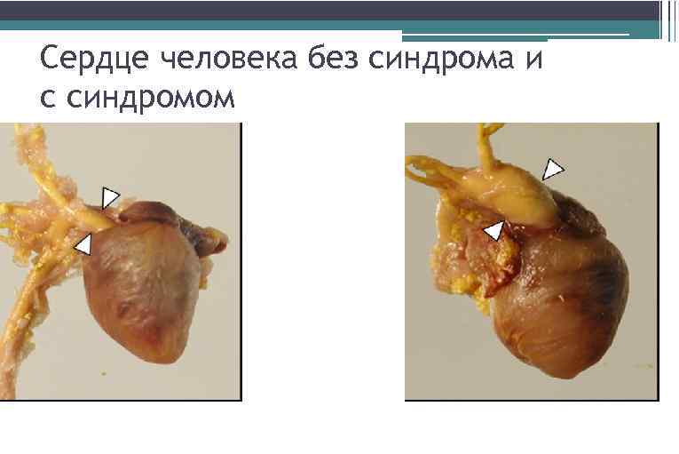Сердце человека без синдрома и с синдромом 