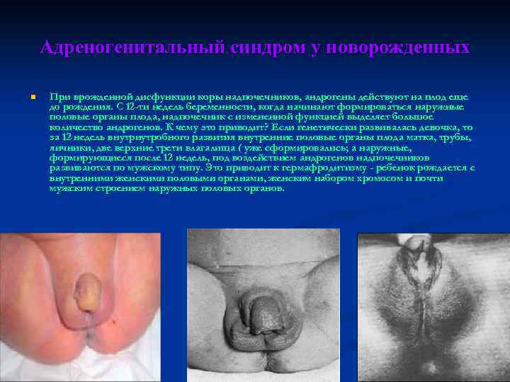 Адреногенитальный синдром у новорожденных n При врожденной дисфункции коры надпочечников, андрогены действуют на плод