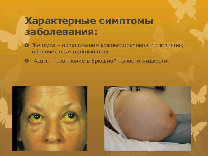 Характерные симптомы заболевания: Желтуха – окрашивание кожных покровов и слизистых оболочек в желтушный цвет