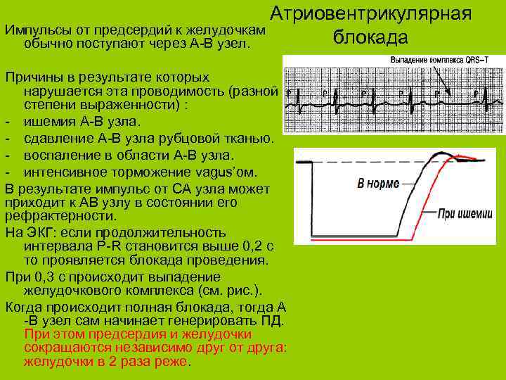 Какие есть импульсы. Причины атриовентрикулярной блокады. Блокады физиология. Блокада проведения импульса. Полная АВ блокада клиника.