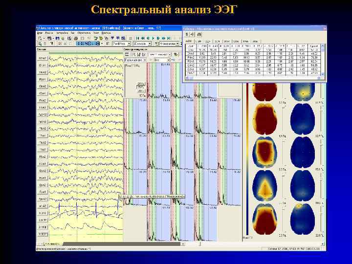 Спектральный анализ ЭЭГ 