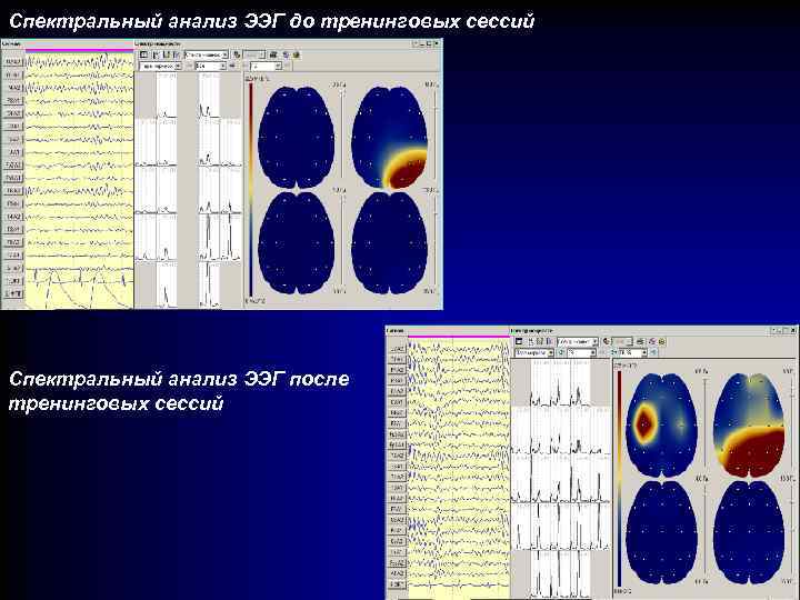 Спектральный анализ ЭЭГ до тренинговых сессий Спектральный анализ ЭЭГ после тренинговых сессий 