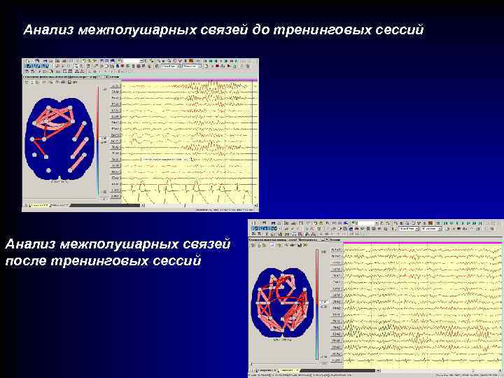Анализ межполушарных связей до тренинговых сессий Анализ межполушарных связей после тренинговых сессий 