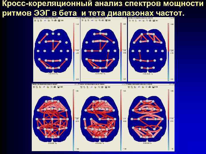 Кросс-кореляционный анализ спектров мощности ритмов ЭЭГ в бета и тета диапазонах частот. 