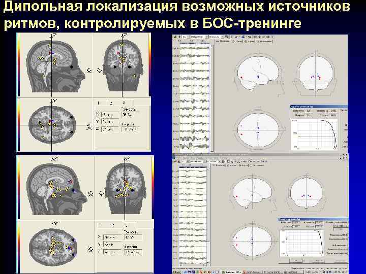 Дипольная локализация возможных источников ритмов, контролируемых в БОС-тренинге 