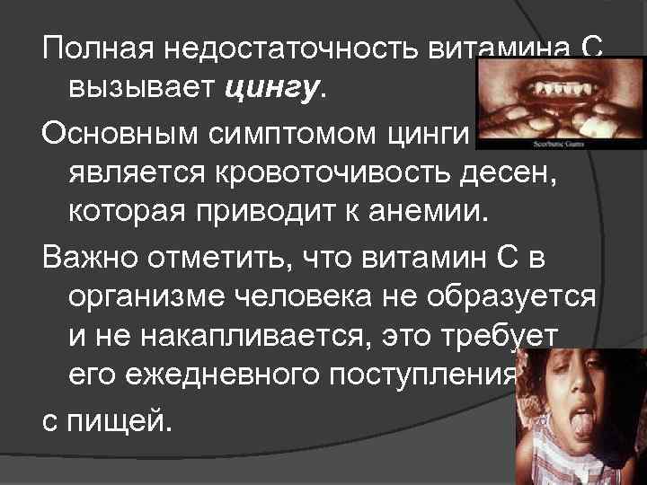 Полная недостаточность витамина С вызывает цингу. Основным симптомом цинги является кровоточивость десен, которая приводит