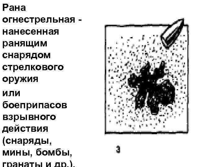 Рана огнестрельная - нанесенная ранящим снарядом стрелкового оружия или боеприпасов взрывного действия (снаряды, мины,