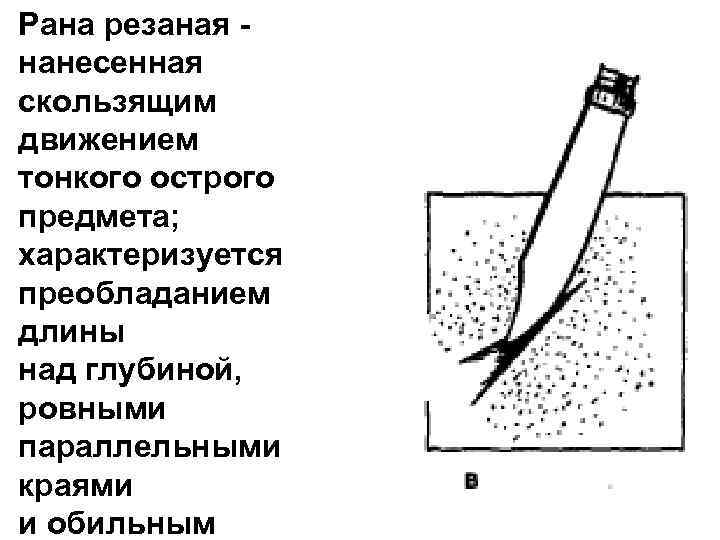 Рана резаная - нанесенная скользящим движением тонкого острого предмета; характеризуется преобладанием длины над глубиной,