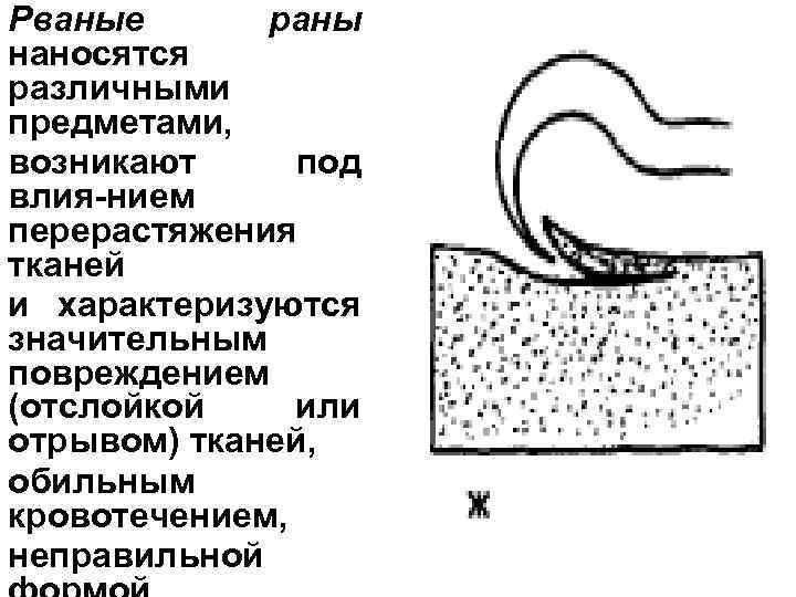 Рваные раны наносятся различными предметами, возникают под влия-нием перерастяжения тканей и характеризуются значительным повреждением