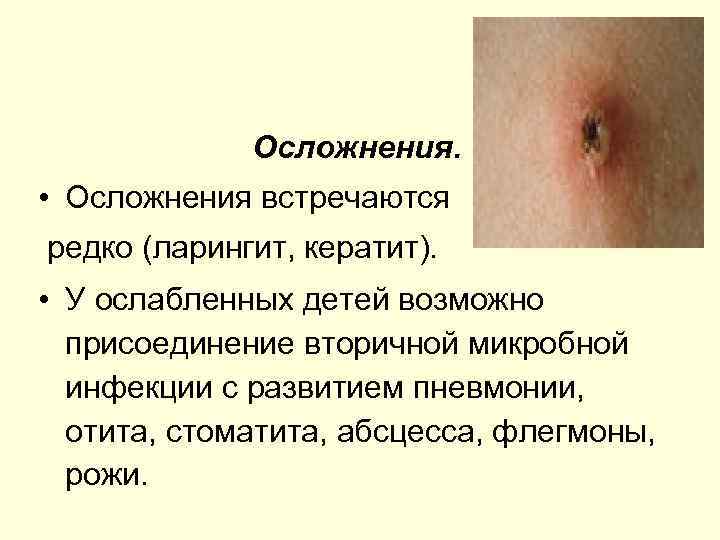 Осложнения. • Осложнения встречаются редко (ларингит, кератит). • У ослабленных детей возможно присоединение вторичной
