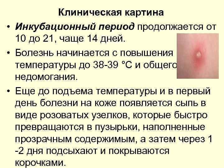 Клиническая картина • Инкубационный период продолжается от 10 до 21, чаще 14 дней. •