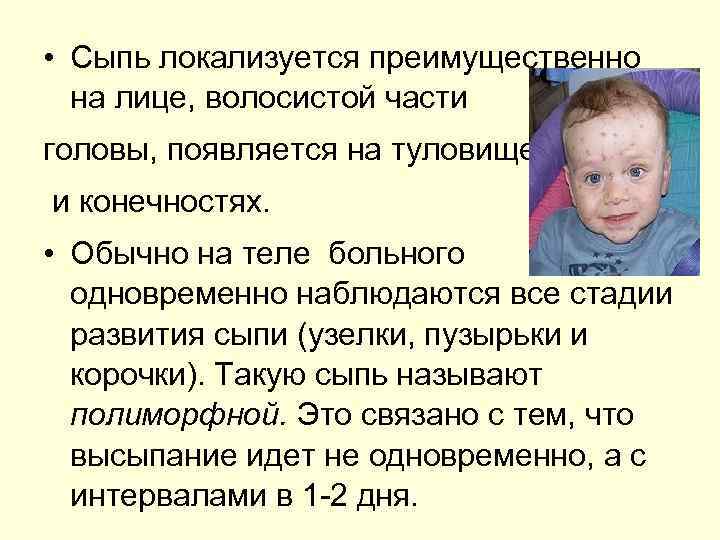  • Сыпь локализуется преимущественно на лице, волосистой части головы, появляется на туловище и