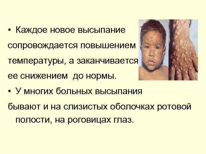  • Каждое новое высыпание сопровождается повышением температуры, а заканчивается ее снижением до нормы.