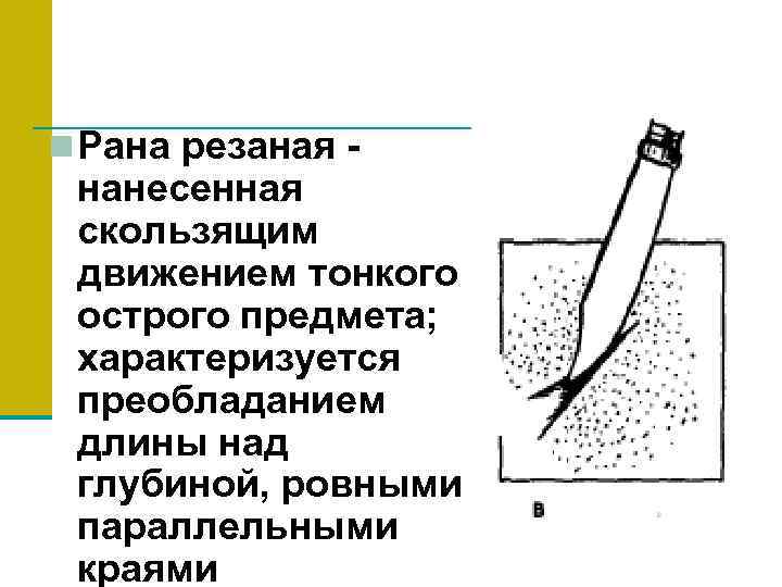 n Рана резаная - нанесенная скользящим движением тонкого острого предмета; характеризуется преобладанием длины над